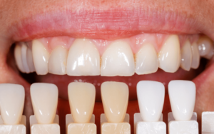 Composite Veneers