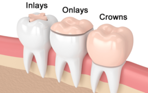 Inlays and Onlays in Cosmetic DentistryComposite inlays and onlays