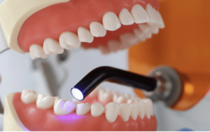 Inlays and Onlays in Cosmetic DentistryInlay/onlay placement procedure