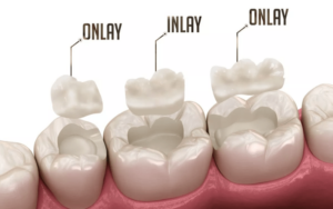 Inlays and Onlays in Cosmetic DentistryPorcelain Inlays and Onlays